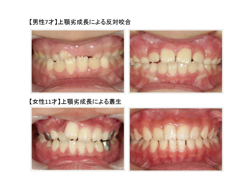 歯科矯正治療と顎顔面矯正治療 - 健康/医学