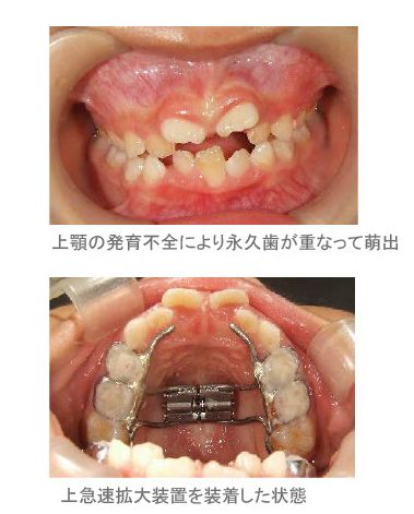 歯科矯正治療と顎顔面矯正治療
