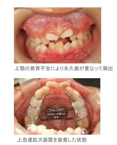 歯科矯正治療と顎顔面矯正治療 - 健康/医学